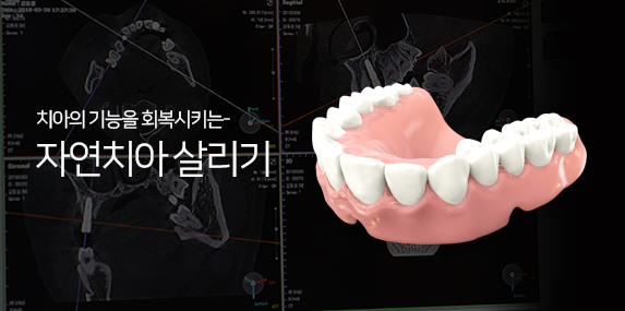 치아의 기능을 회복시키는 자연치아 살리기